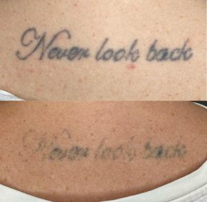 Before and after image of laser tattoo removal on back of neck.