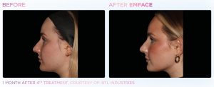 Before and after image of EMFACE for young woman.