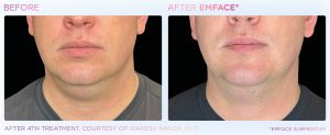 Before and after image for EMFACE for man with double chin.