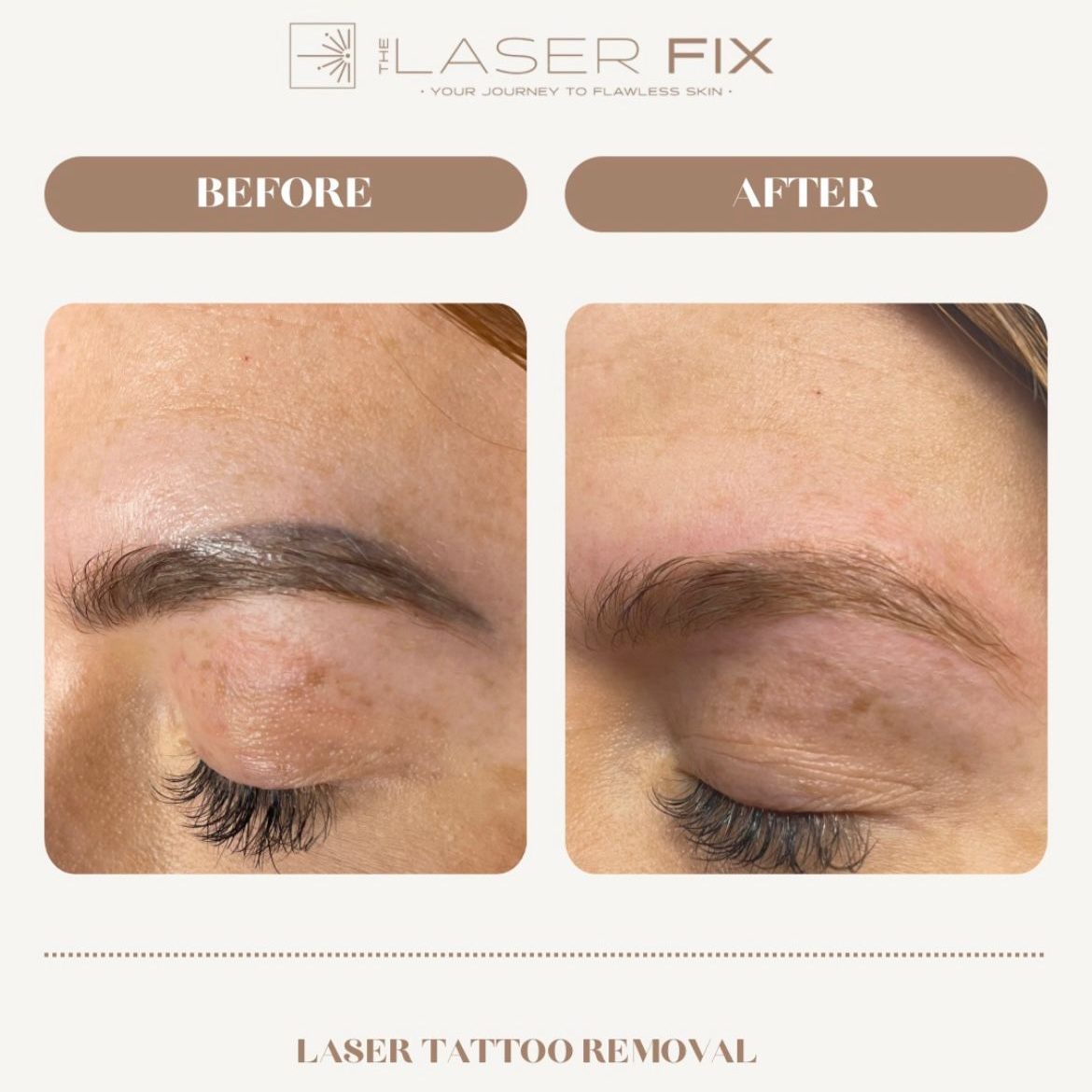 Before and after image of laser tattoo removal for eyebrow microblading.