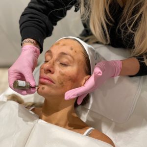 Woman undergoing SQT Bio Microneedling treatment.