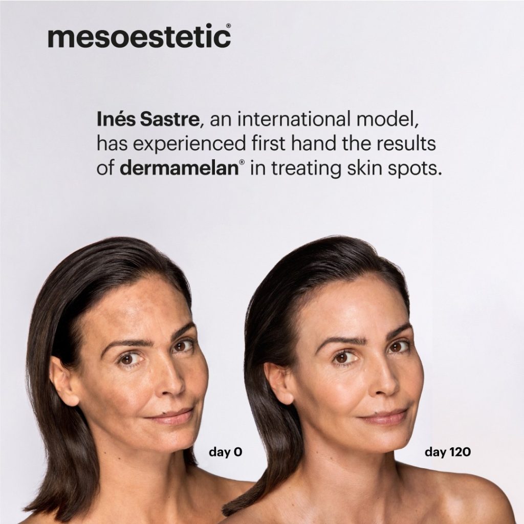 Ines Sastre model before and after from Dermamelan.