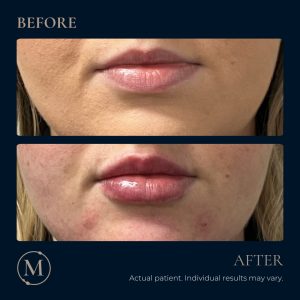 MaiLi fillers before and after.