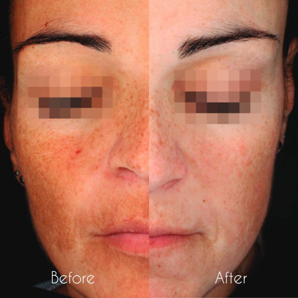Dermamelan Peels before and after treatment birmingham