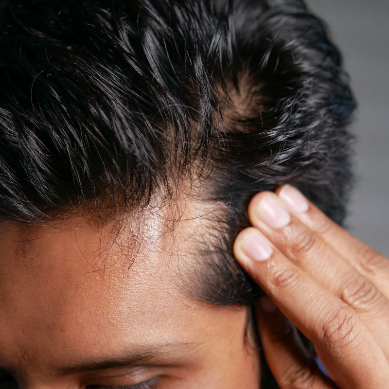 Hair loss treatment birmingham