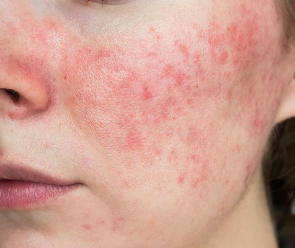 Rosacea condition in birmingham