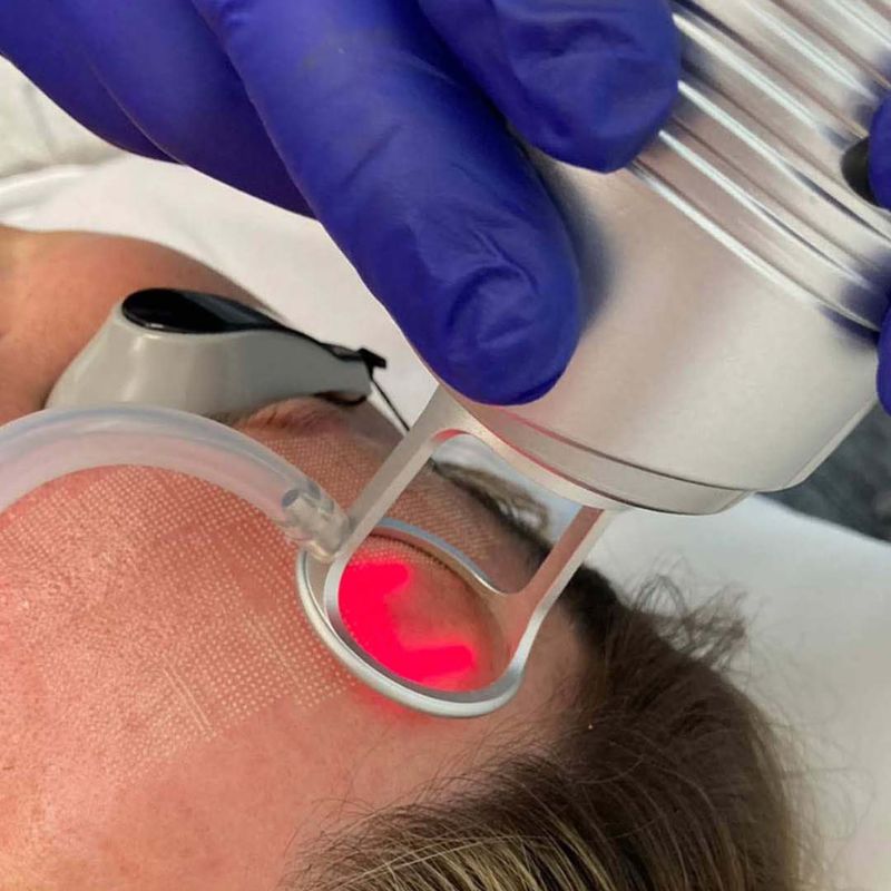 SmartXEL-CO2-Laser-Treatment-Birmingham