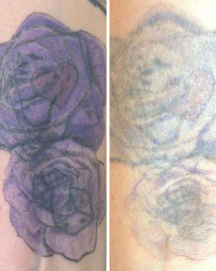 arm tattoo removal in birmingham