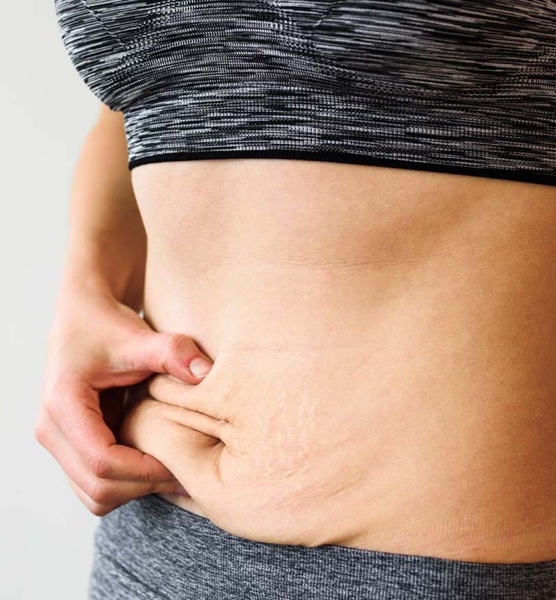 before emsculpt neo treatment in birmingham