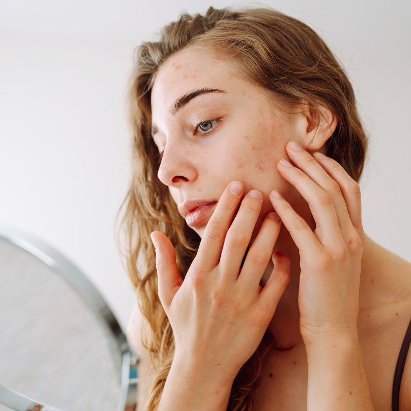 before microneedling treatment concerned with skin birmingham