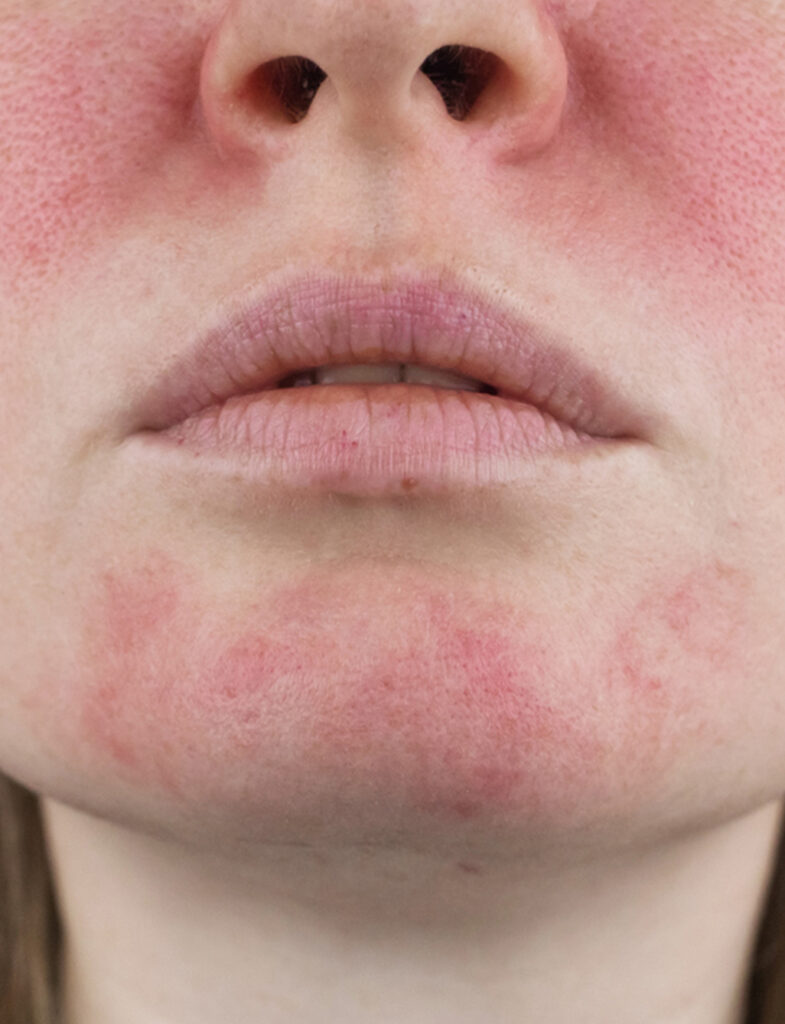 before rosacea birmingham