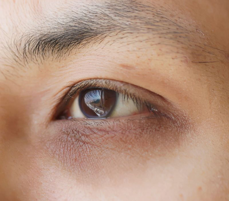 dark circle treatment in birmingham