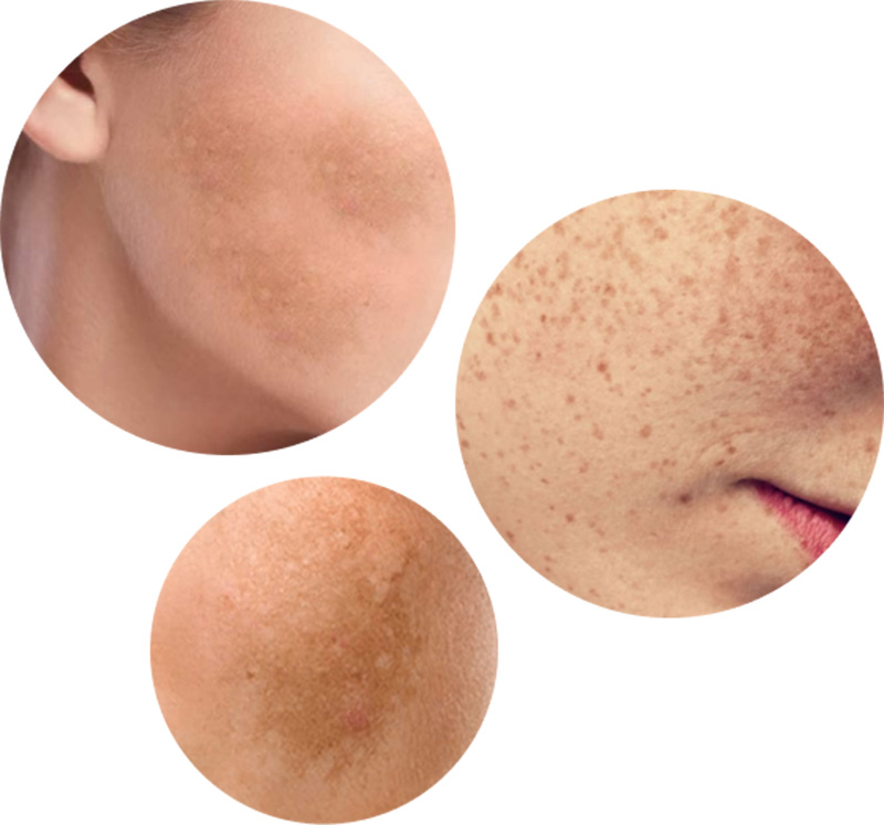 dermamelan skin concerns in birmingham