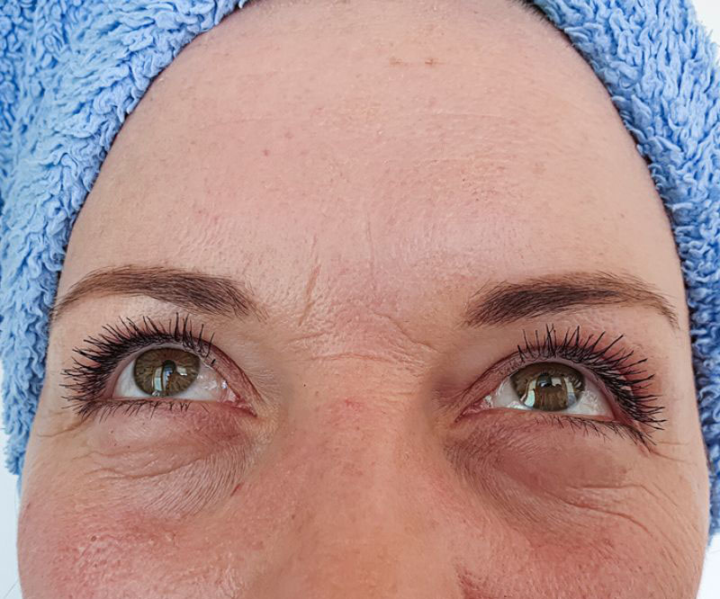 eye wrinkle and dark circle treatment birmingham