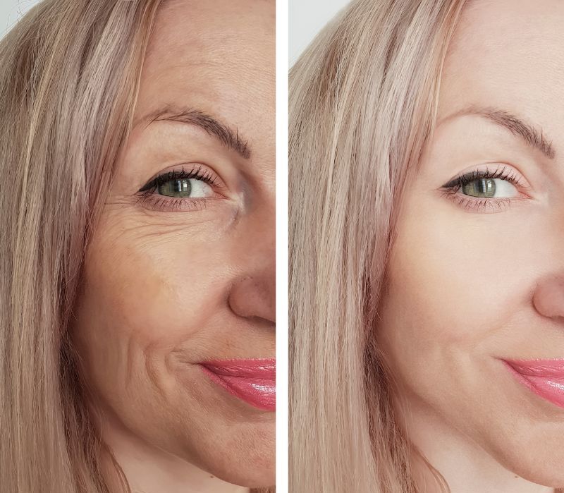 fine lines before and after birmingham