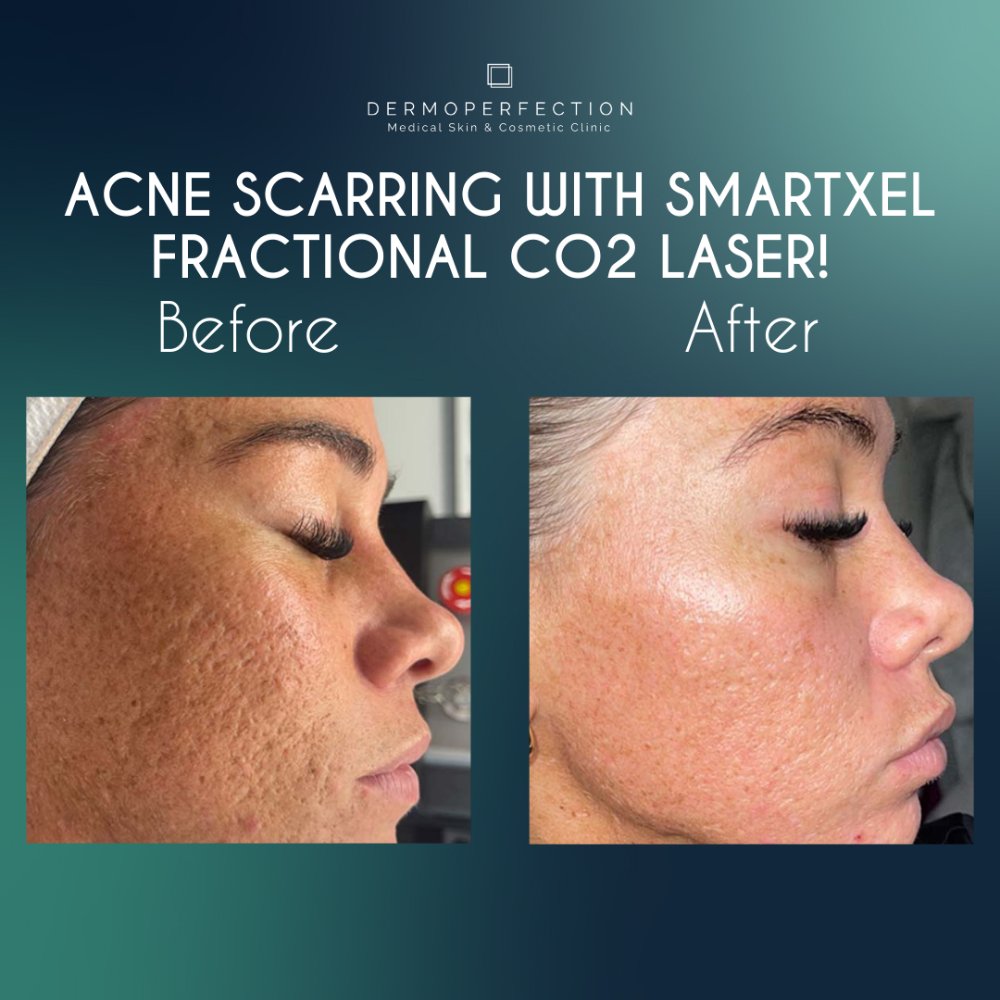 fractional co2 laser acne-scarring before and after results birmingham