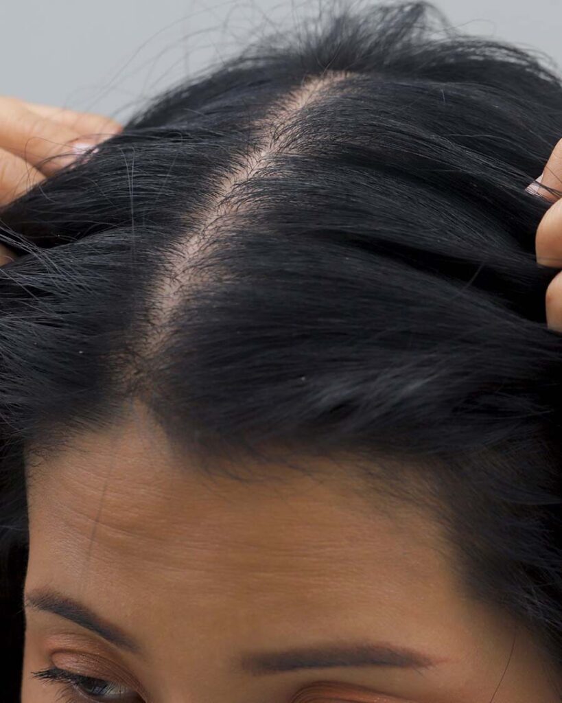 hair thinning treatment solution birmingham