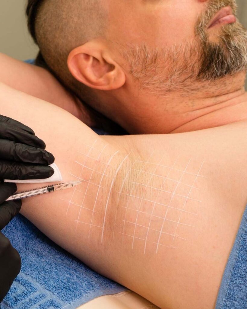 hyperhidrosis treatment in birmingham