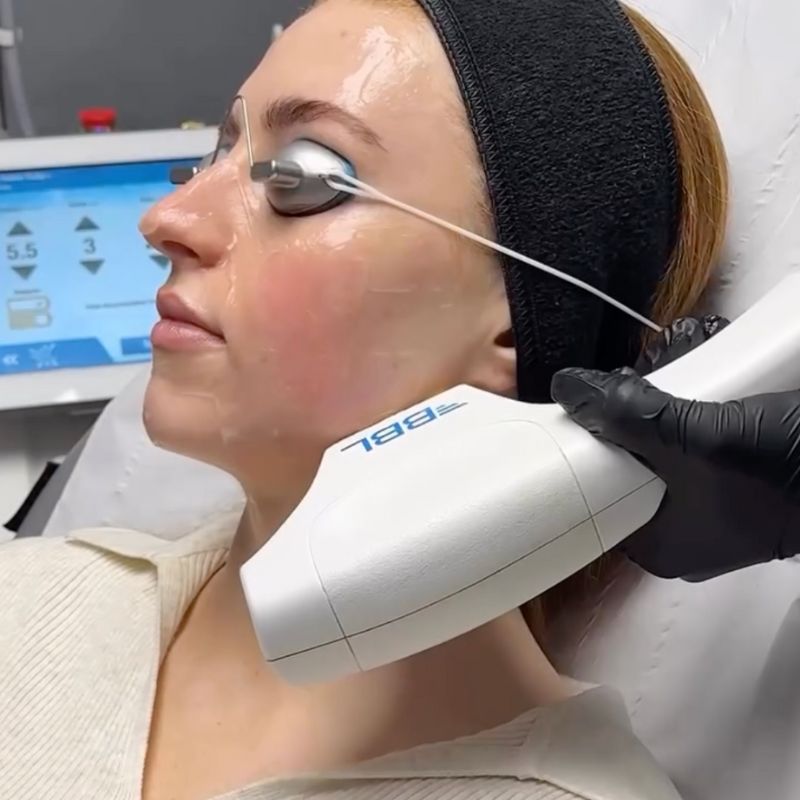 laser hair removal session in birmingham