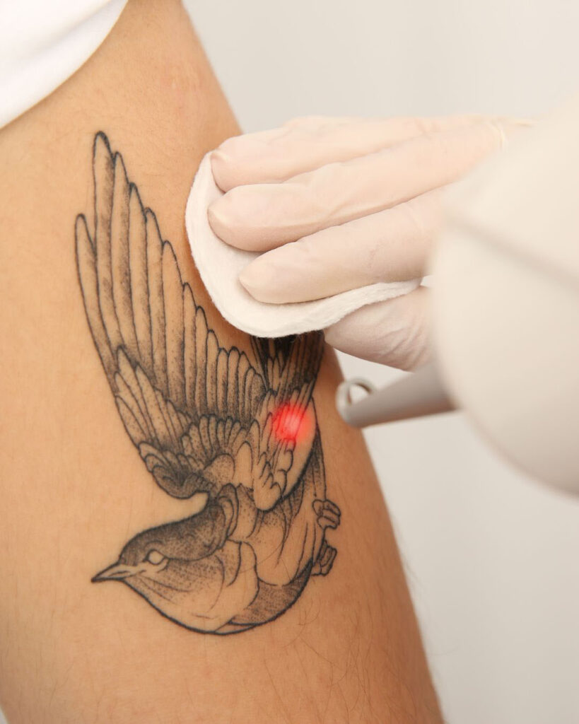 laser tattoo removal in birmingham
