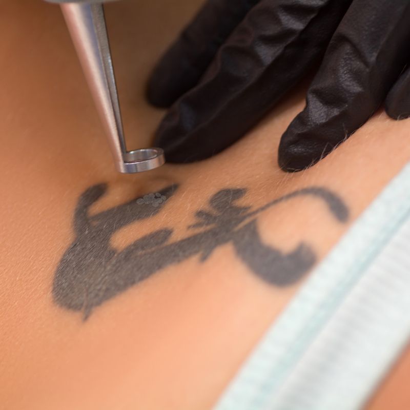 laser tattoo removal session close birmingham