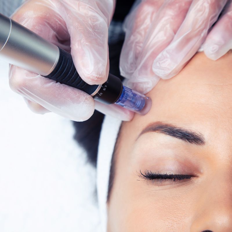 microneedling treatment birmingham