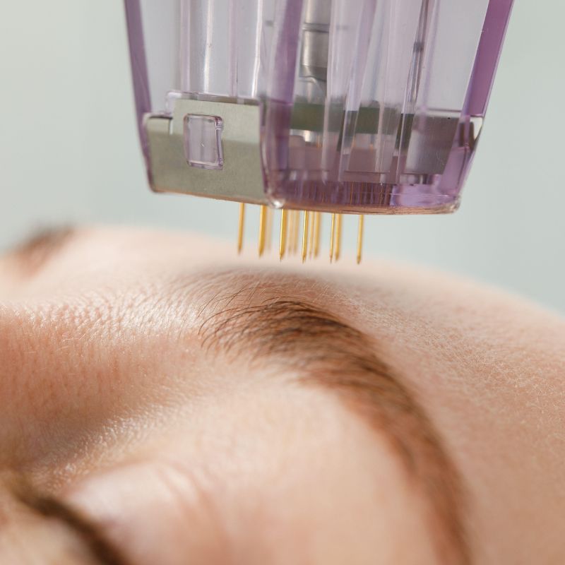 microneedling treatment close up in birmingham