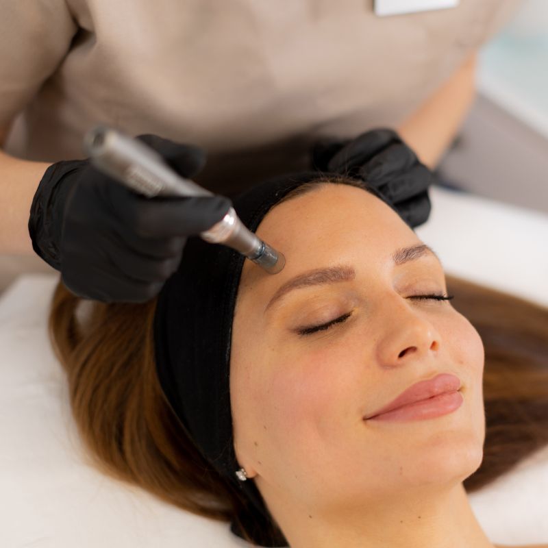 microneedling treatment session birmingham