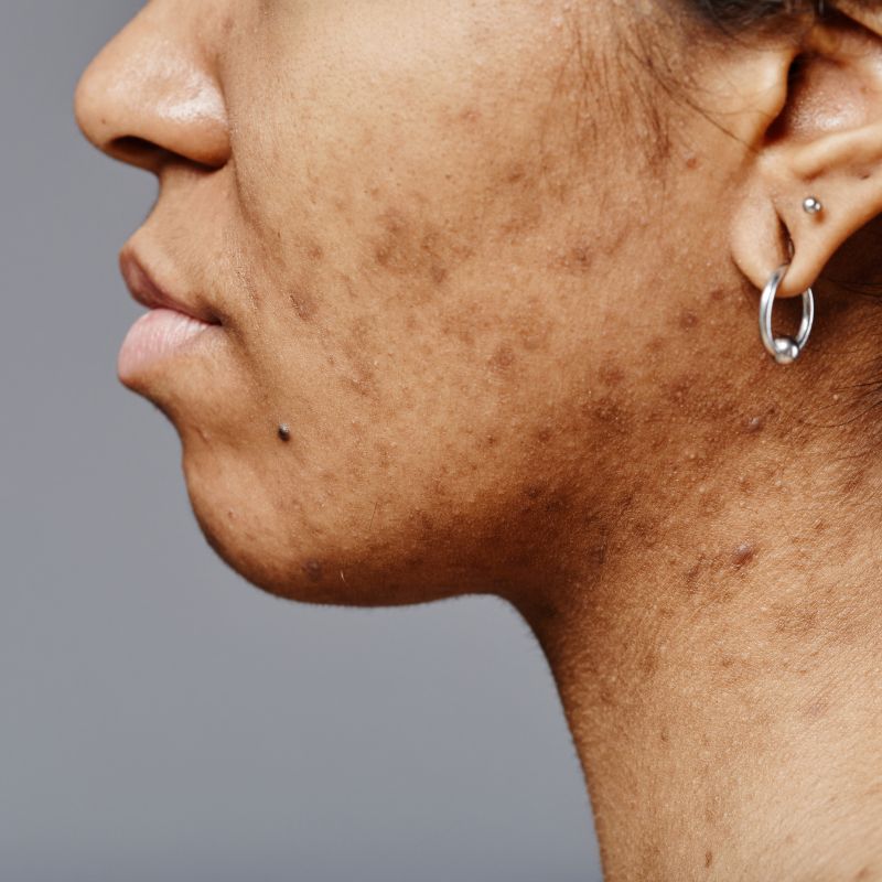 skin concerns at dermoperfection birmingham