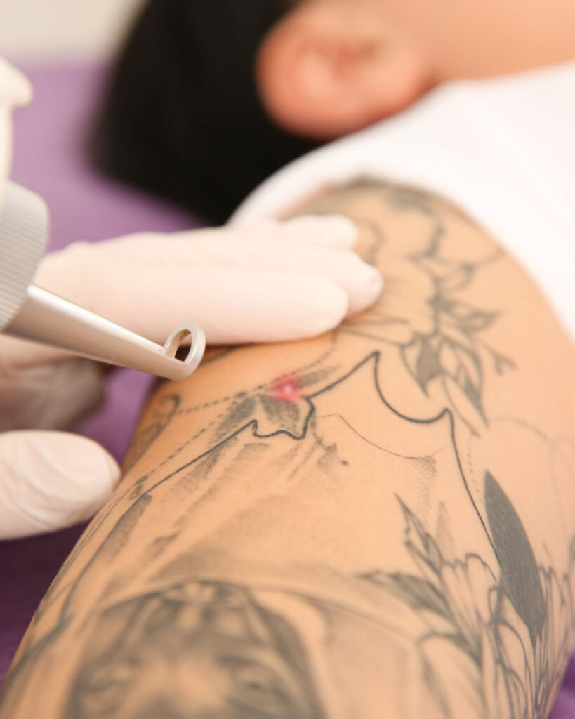 tattoo removal session in birmingham