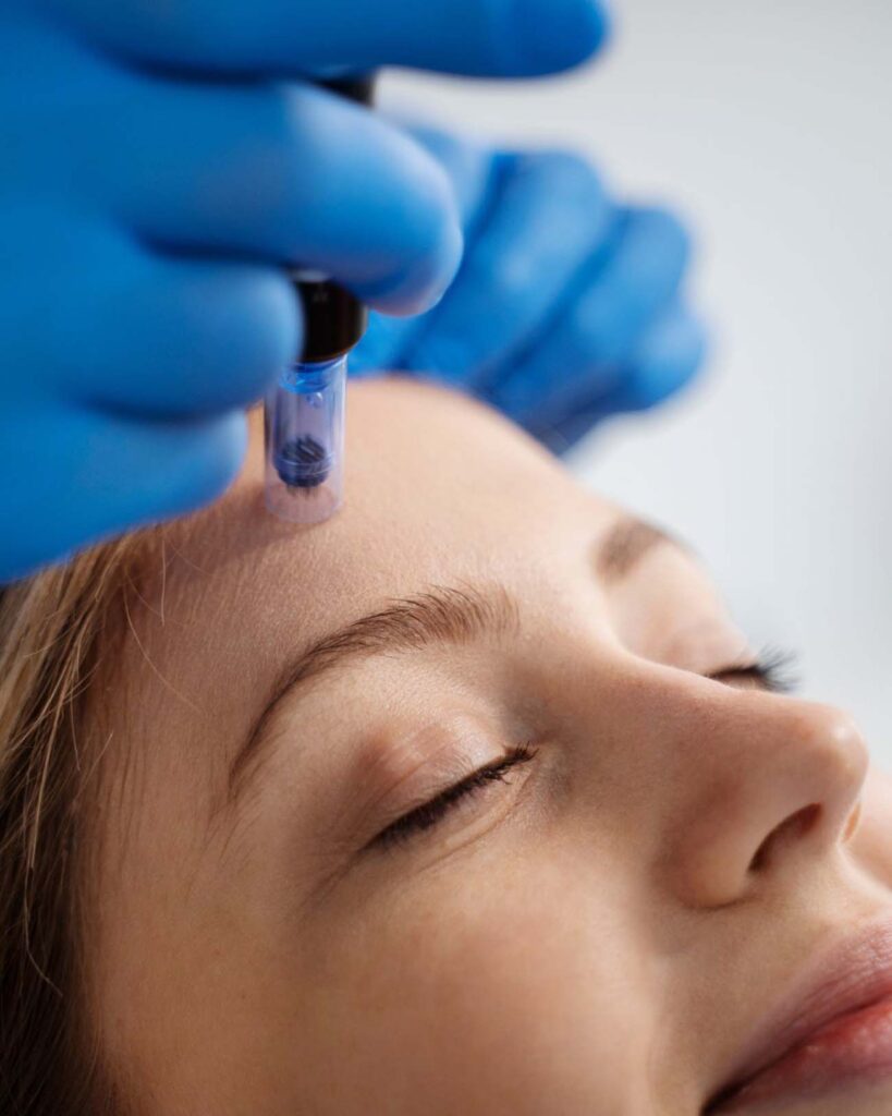 woman getting microneedling treatment in birmingham