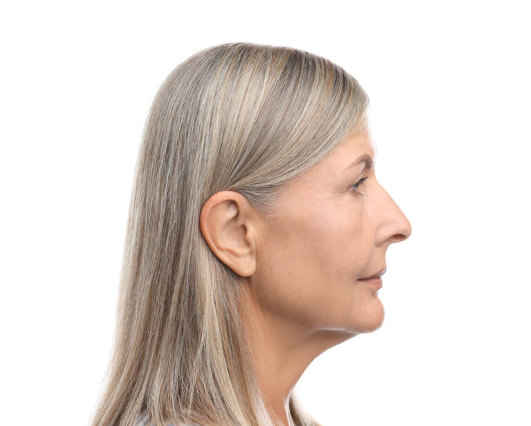 non surgical facelift image