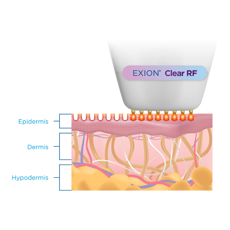 Diagram showing EXION Clear RF delivering radiofrequency energy through the epidermis, dermis and hypodermis to stimulate collagen and tighten skin
