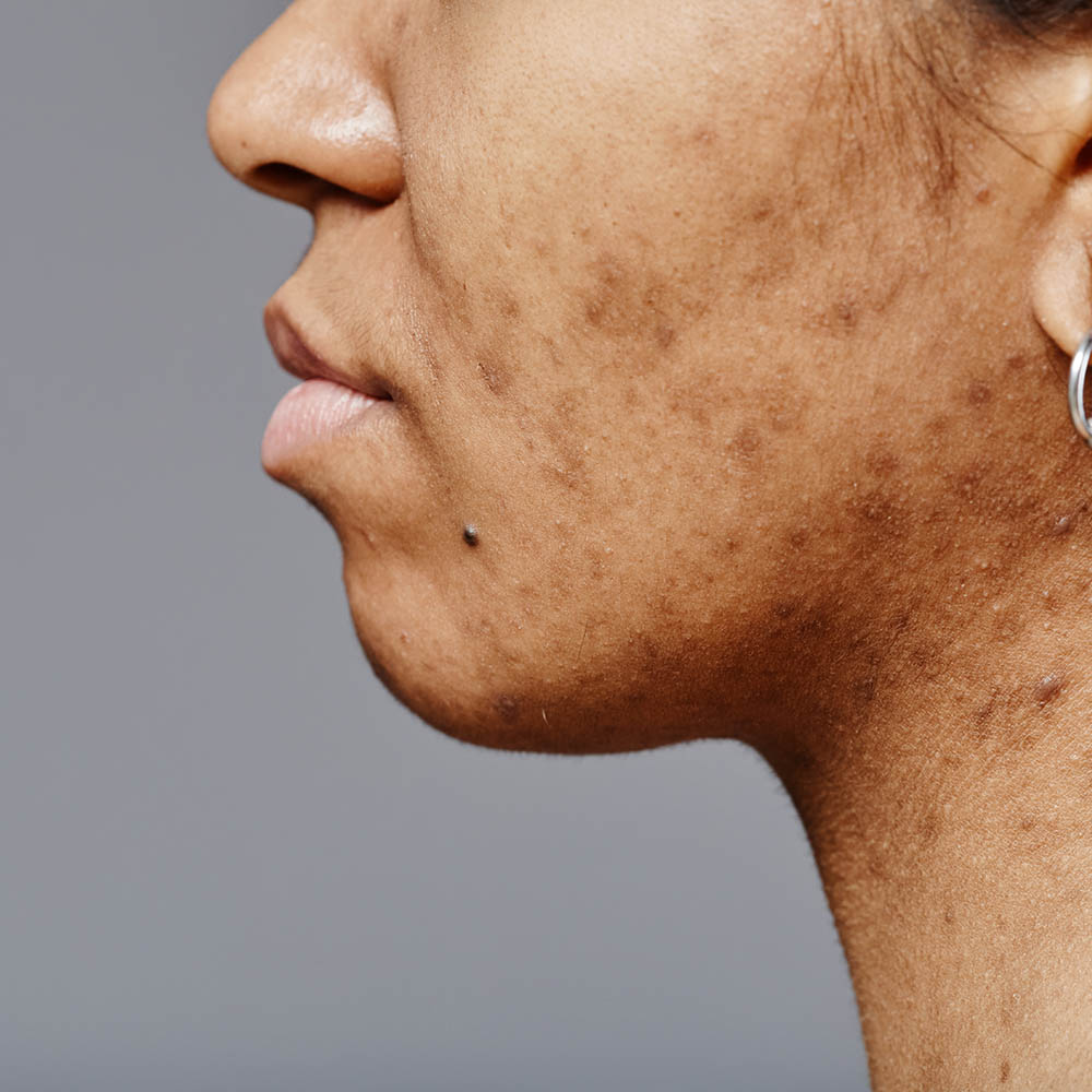 Side profile of a woman's lower face and neck showing dark spots and acne scars (hyperpigmentation) on the skin.