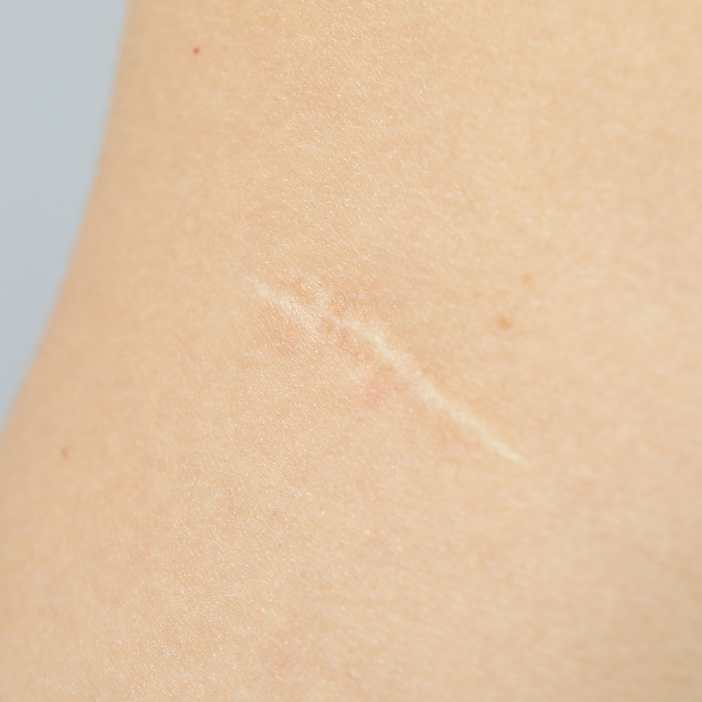 Close-up of light skin with a faint diagonal scar running across.