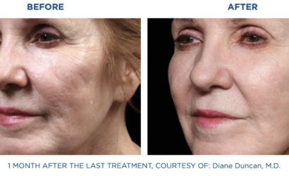 Before and after close-up of a woman's face showing smoother skin after treatment.