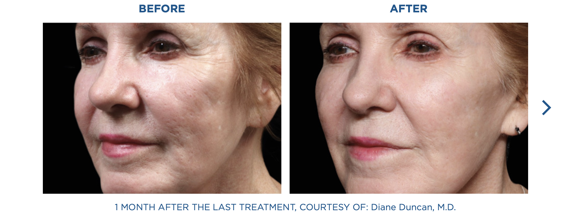 Before and after close-up of a woman's face showing smoother skin after treatment.