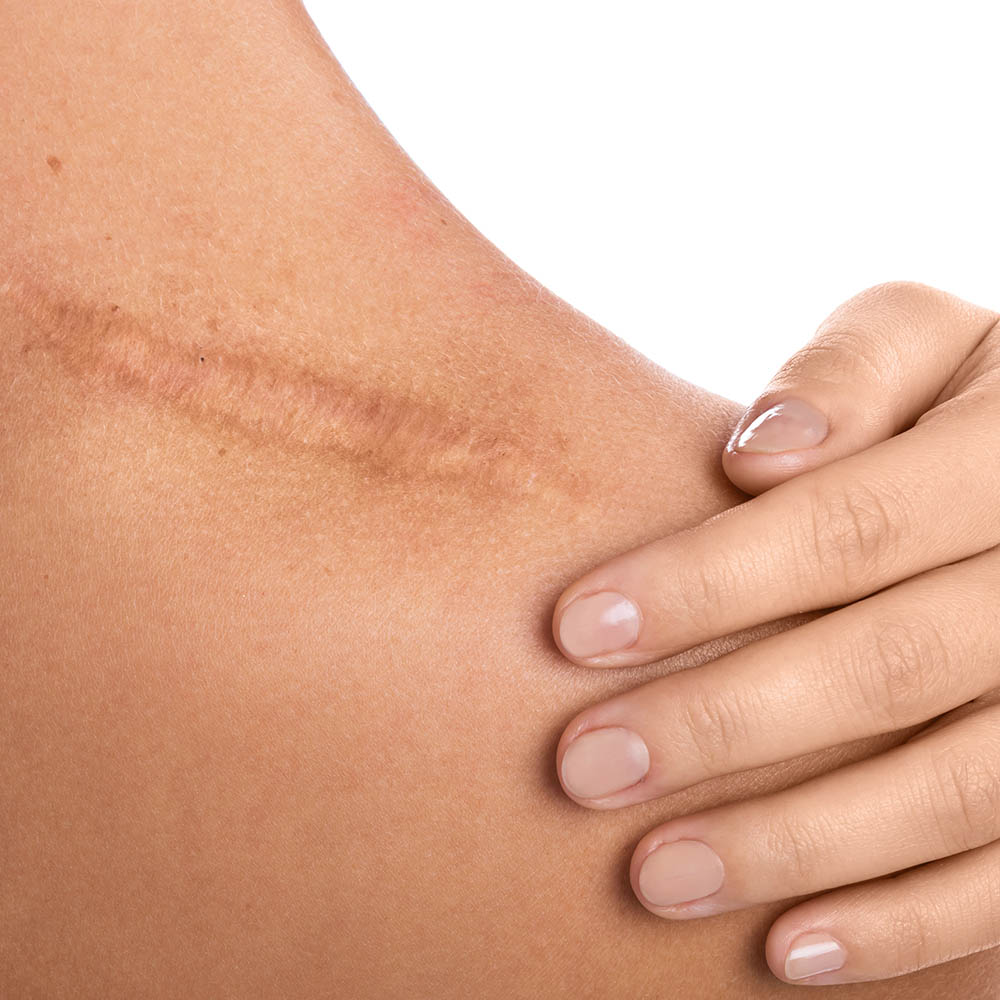 Close-up of the side/back of a neck showing a linear scar or stretch marks, with a hand resting on the area for support or scale.